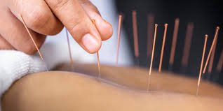 Challenor Acupuncture